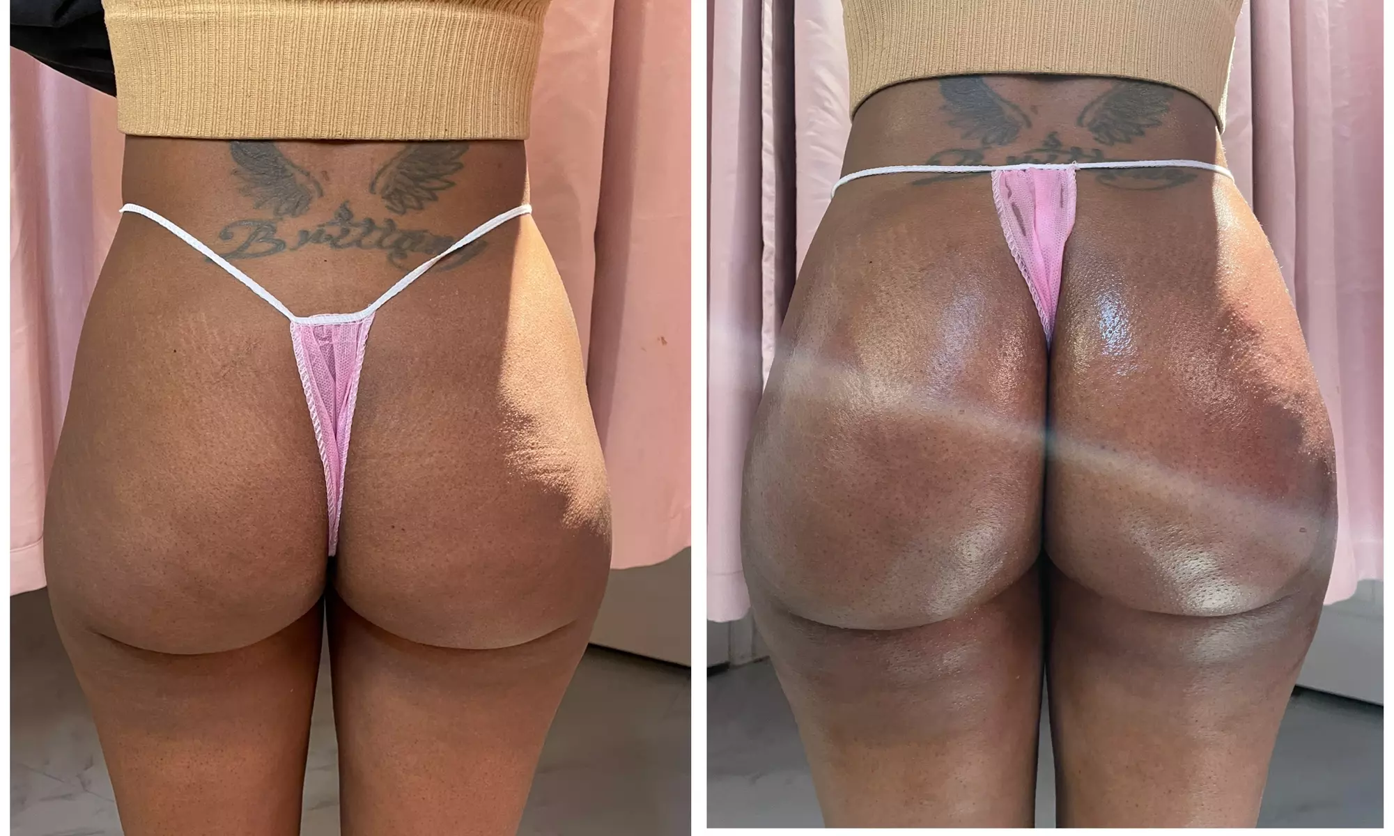 Lift and tone with nonsurgical butt cupping sessions