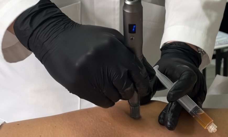 Image 2: Microneedling Glow Boost: Classic, Stem Cell & Vitamin C Options