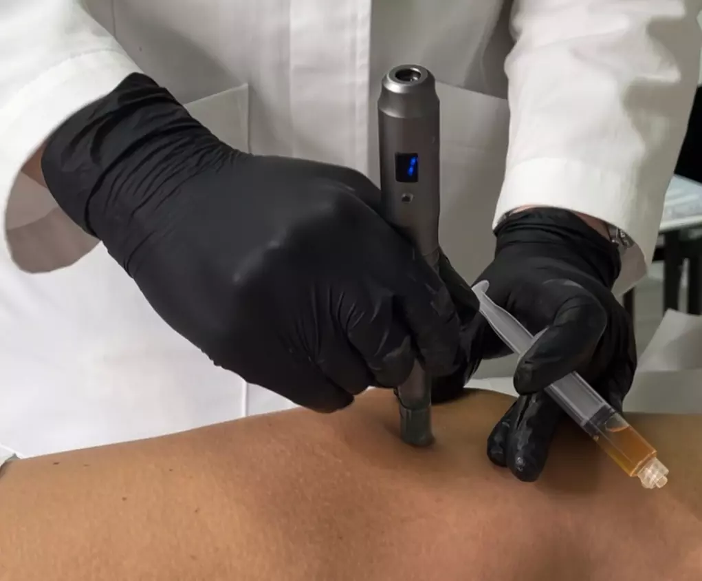 Microneedling Glow Boost: Classic, Stem Cell & Vitamin C Options