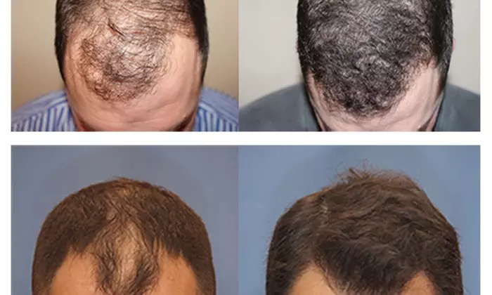 Discover PRP Hair Restoration at Mariam Aesthetics Clinic with up to 53% discount on treatment options - Primary Image