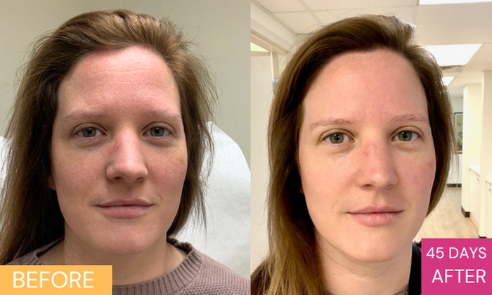 Revitalize Your Skin with PRF Micro-Needling Vampire Facial