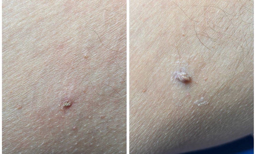 Image 7: Up to Unlimited Skin Tags, Milia, Blood Spot or Mole Wart Removal
