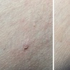 Image 7: Up to Unlimited Skin Tags, Milia, Blood Spot or Mole Wart Removal