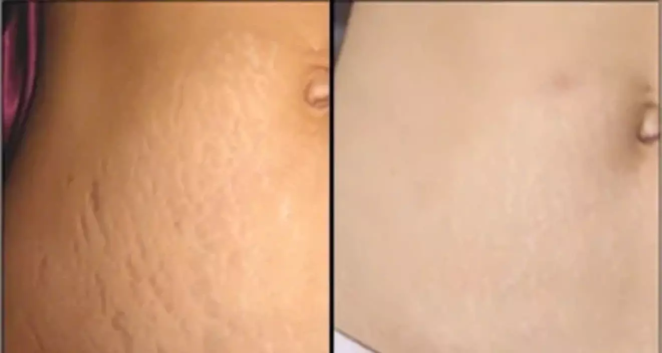 Up to 47% Off on Laser Skin Resurfacing at Hang's Spa