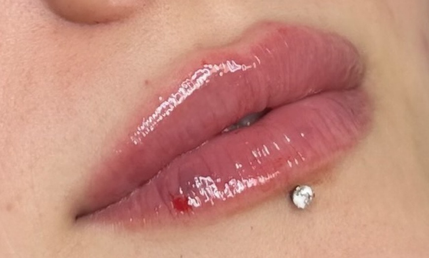 Image 1: Stunning Lips Awaits with 0.5 or 1 ml of Russian Lips Dermal Filler