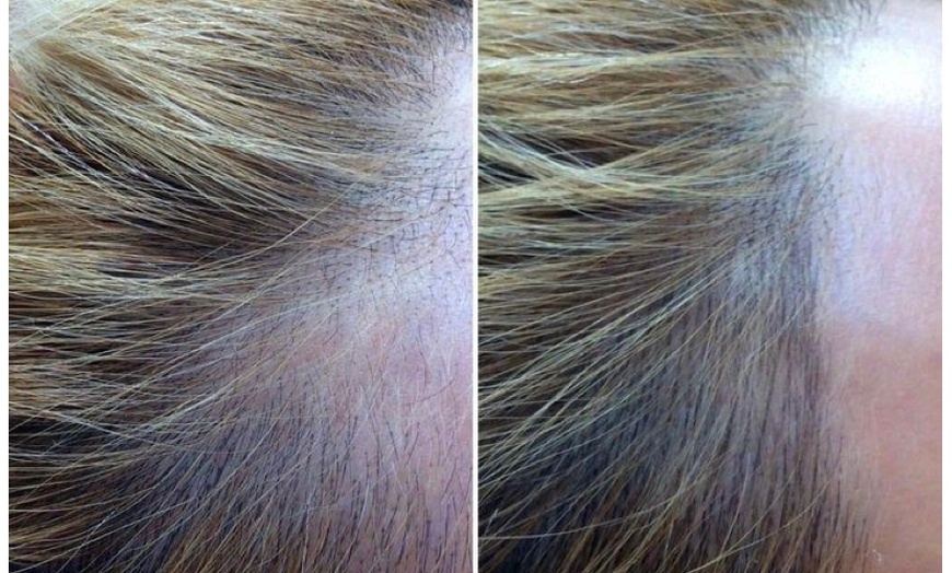 Image 6: Areola Tattoo Treatment, Scalp Micropigmentation Or Cheek Blush Tattoo