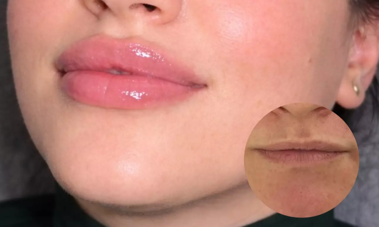 Premium Dermal Filler (REVOLAX®) - 0.5ml or 1ml (Up to 57%Off) - Second Medium