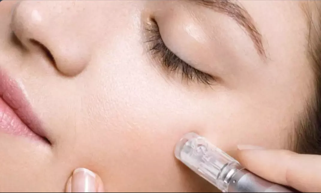 Refresh Your Look with One Micro-Needling Treatment at Amazing Brows Salon and Spa (Up to 64% Off) - Primary Image