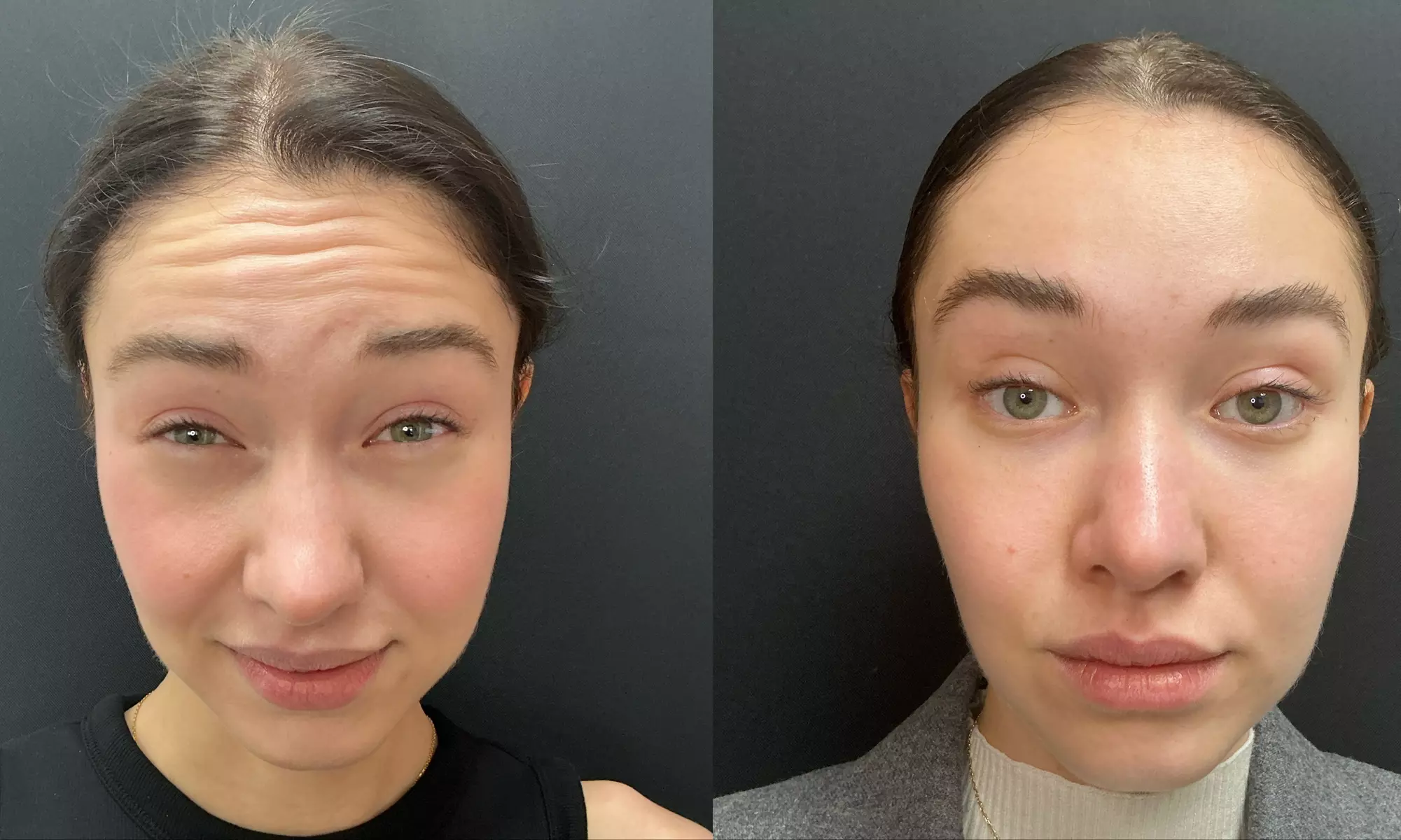 Smooth Away Lines with Botox Lip Flip, 20 or 40 Units of Botox