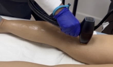 6 Sessions of Laser Hair Reduction on One Small Area (Unibrow, Upper Lip) - TS Hydration and Wellness Medical Center