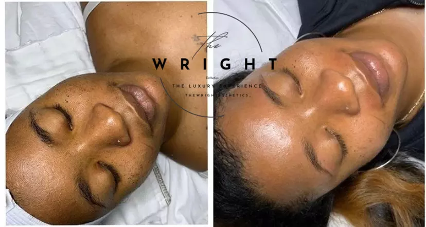 Experience rejuvenating in spa facials at The Wright Esthetics with options for up to 49% off.