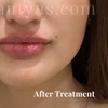 Image 1: Up to 52% Off on Injection - Dermal Filler at One Beauty Aesthetics