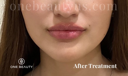 One 0.55ml Syringe of Juvéderm® Volbella - One Beauty Aesthetics