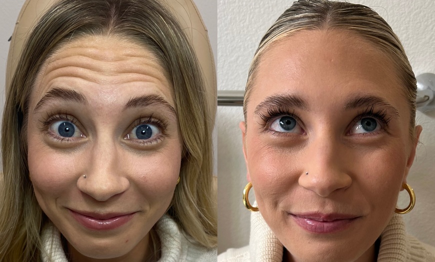 Image 2: Smooth Away Wrinkles with 20, 40 or 60 Units of Xeomin