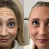 Image 2: Smooth Away Wrinkles with 20, 40 or 60 Units of Xeomin