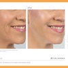 Image 1: Get One or Two Syringes of Skin Booster (Restylane®) 