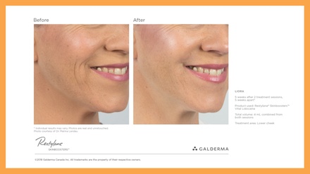Skin Booster (Restylane®) – One Syringe for Hydration & Glow - Derma Med Spa - Frisco