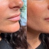 Image 9: Up to 26% Off on Injection - Filler and Freezer at Age Management Optimal Wellness