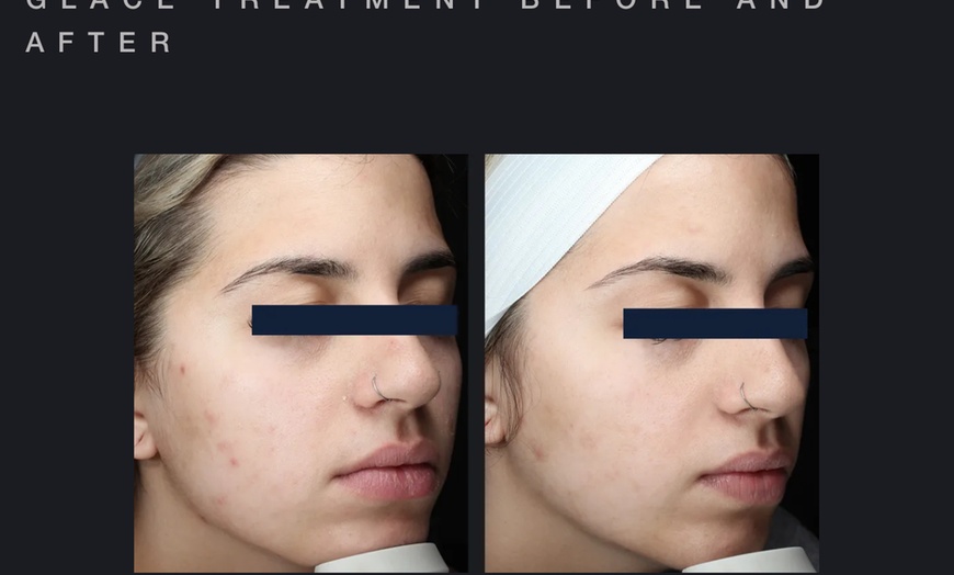 Image 5: Glow with One or Three Glacē™ Skin Treatments