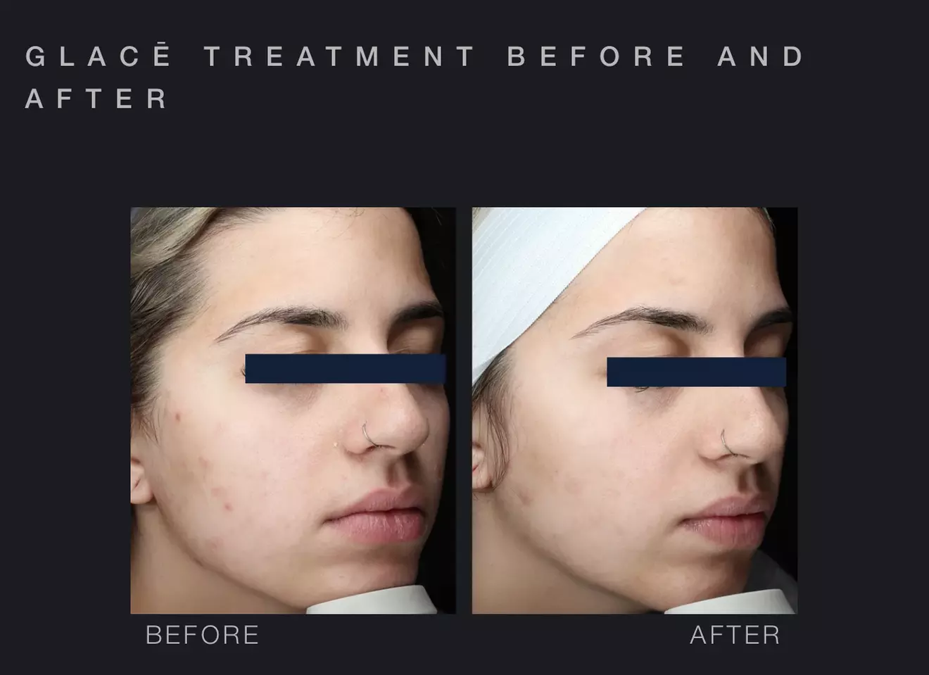 Glow with One or Three Glacē™ Skin Treatments