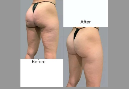 EMS Body Sculpting / Contouring - SThree Wellness