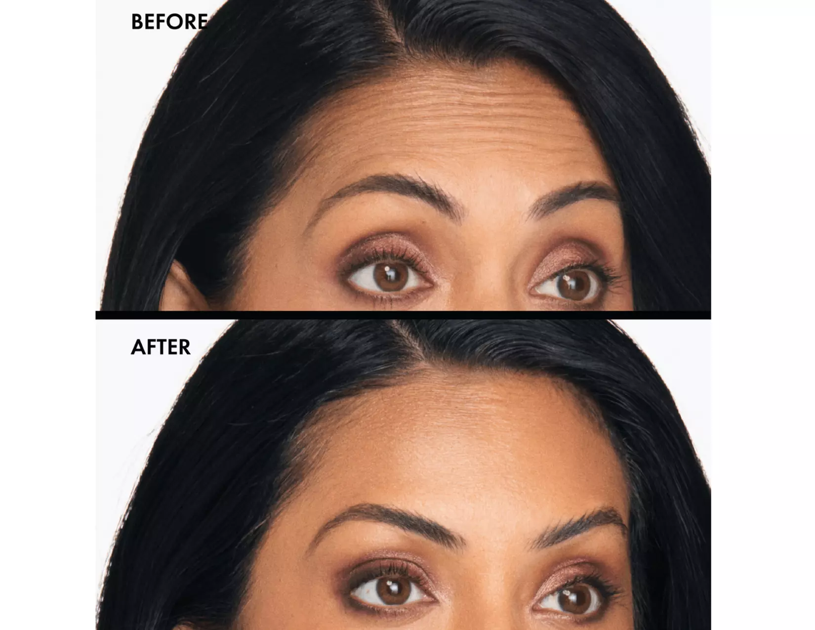 Up to 46% Off on Injection - Xeomin at Lumina Wellness Center - Primary Image