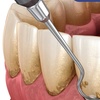Image 3: Comprehensive Dental Checkup with X-Rays and Cancer Screening
