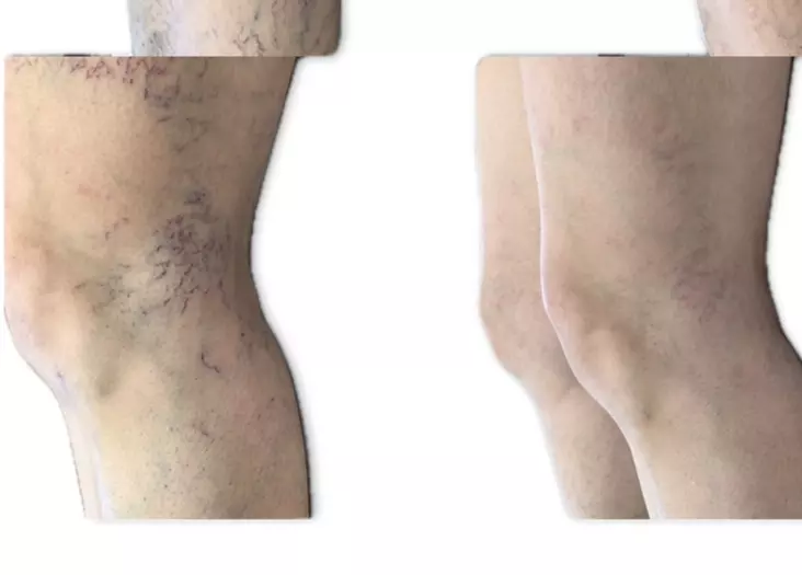 One or Two: Spider Vein Treatments with Complimentary Consultation