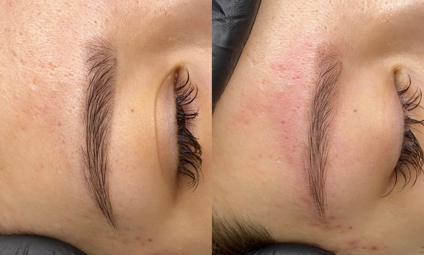 Image 2: Laserowe usuwanie tatuażu i makijażu permanentnego