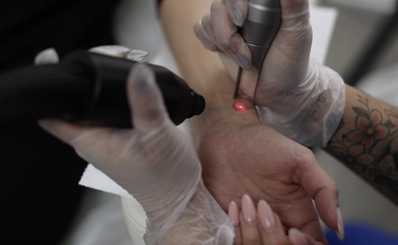 Three Laser Tattoo-Removal Sessions for Up to 4 Square Inches - Step Up Skin Laser