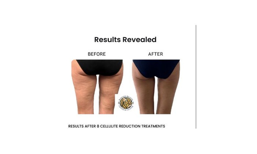 Image 6: One 30 Minutes or 1 Hour Venus Legacy Face or Body Sculpting Session