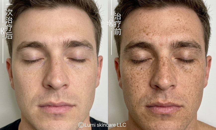 Image 2: 1 or 3 IPL Acne, Melasma, Brown Spots, or Rejuvenation Treatments
