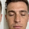 Image 2: 1 or 3 IPL Acne, Melasma, Brown Spots, or Rejuvenation Treatments
