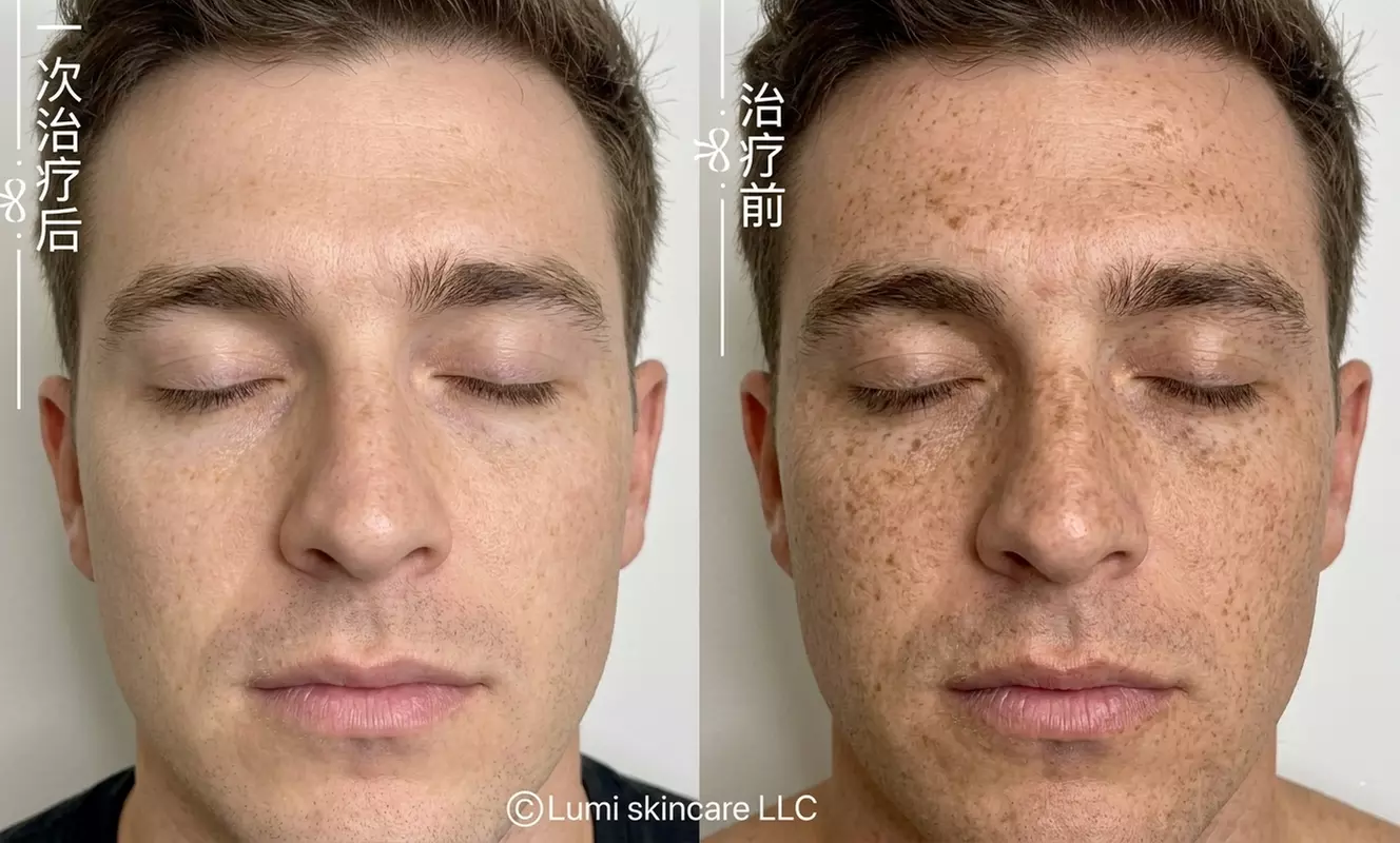 1 or 3 IPL Acne, Melasma, Brown Spots, or Rejuvenation Treatments