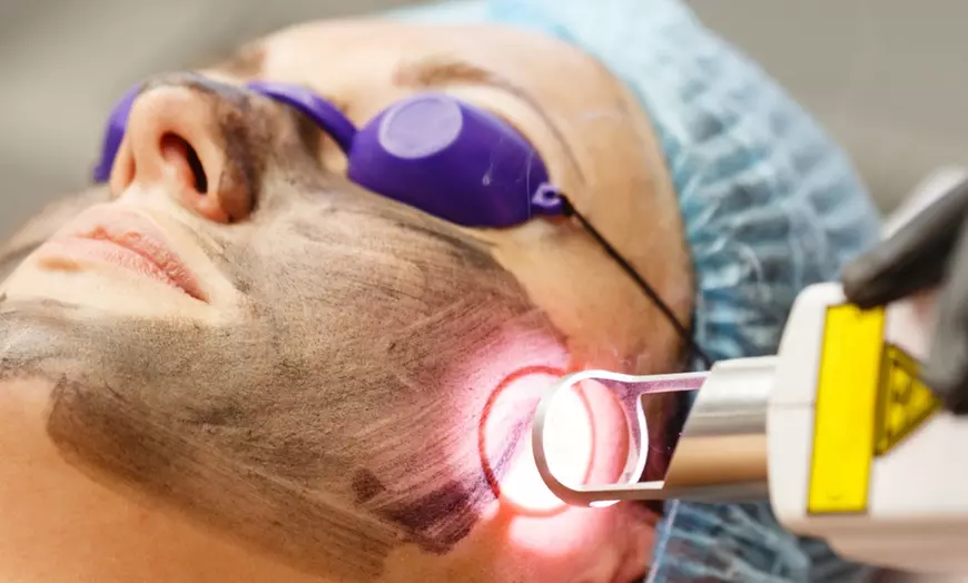 Image 1: Get Glowing Skin with 1 or 6 Sessions of Carbon Laser Peel Facial at Agatha K Micropigmentation (Up to 48% Off)