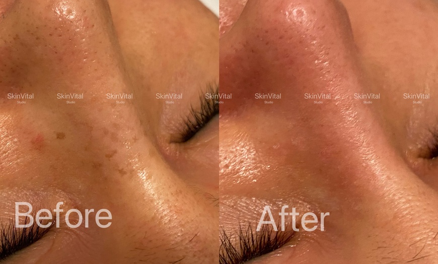Image 2: Pico Laser Sessions for Small Targeted Areas – 1 or 3 Options 