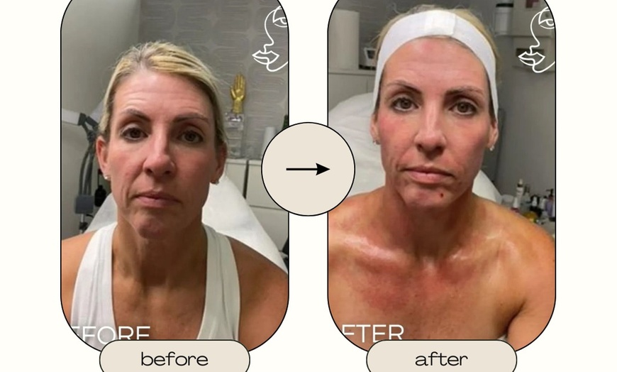 Image 3: Up to 50% Off on Candela RF Microneedling at Ziocorps Esthetique
