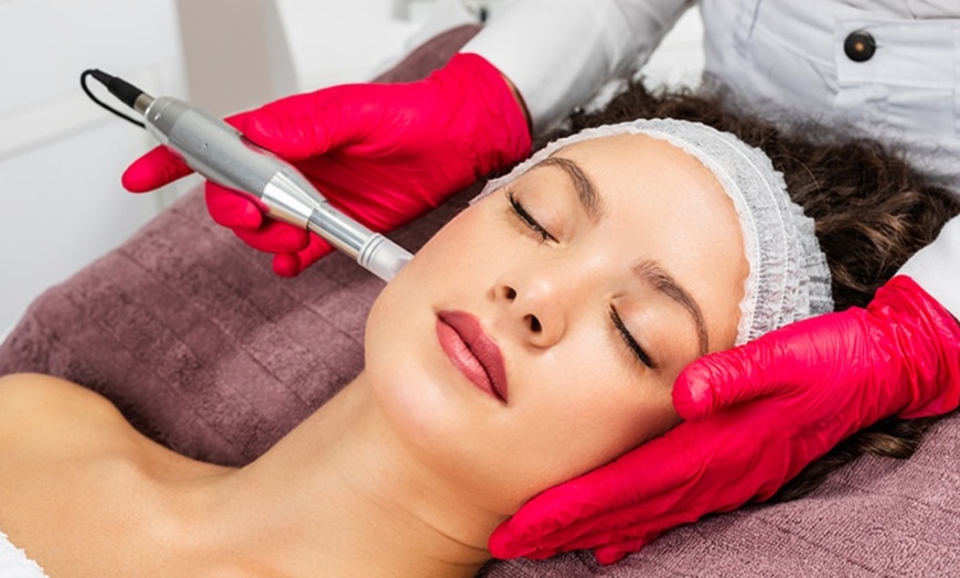 Image 1: Dermaplane (Fresh & Glow) & Microneedling +HA - 1, 2, 3, or 6 Sessions