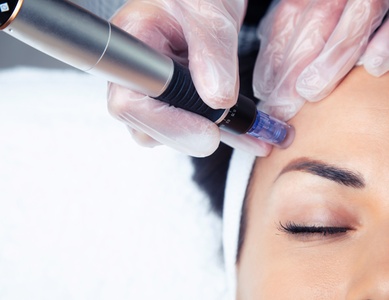 One Micro Needling Treatment + Acupuncture session - Cricks Chiropractic and Acupuncture