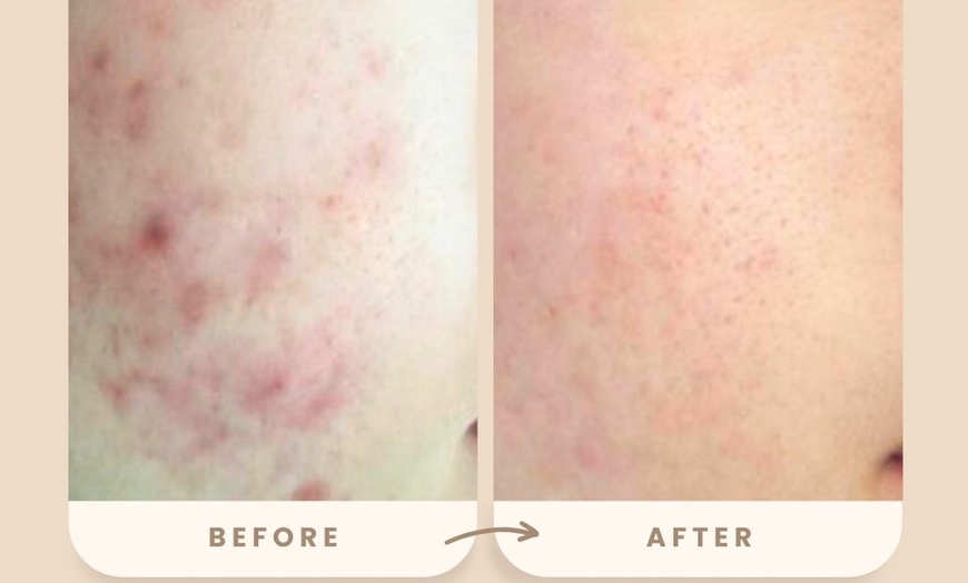 Image 3: Reverse Ageing & Repair Scars: Sylfirm X (One, Two, or Three Sessions)