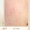Image 3: Reverse Ageing & Repair Scars: Sylfirm X (One, Two, or Three Sessions)