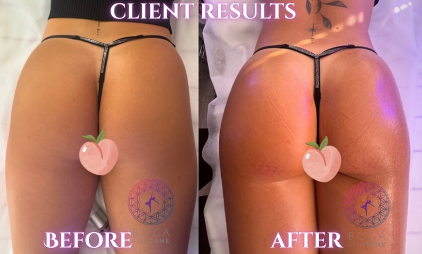 Image 3: Discover Non-Surgical BumBum Butt Lift Sessions