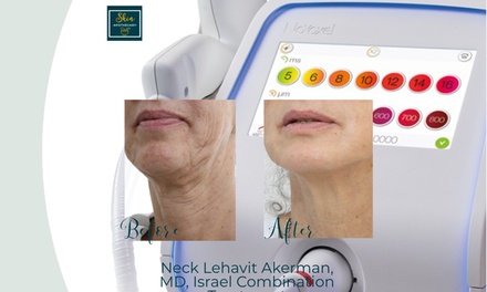 Tixel Fractional Skin-Resurfacing Session for the Face - Skin Apothecary