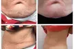 Non-Surgical Solution: Fix Stubborn Fat with Lipo Sculpt Lite - Second Medium