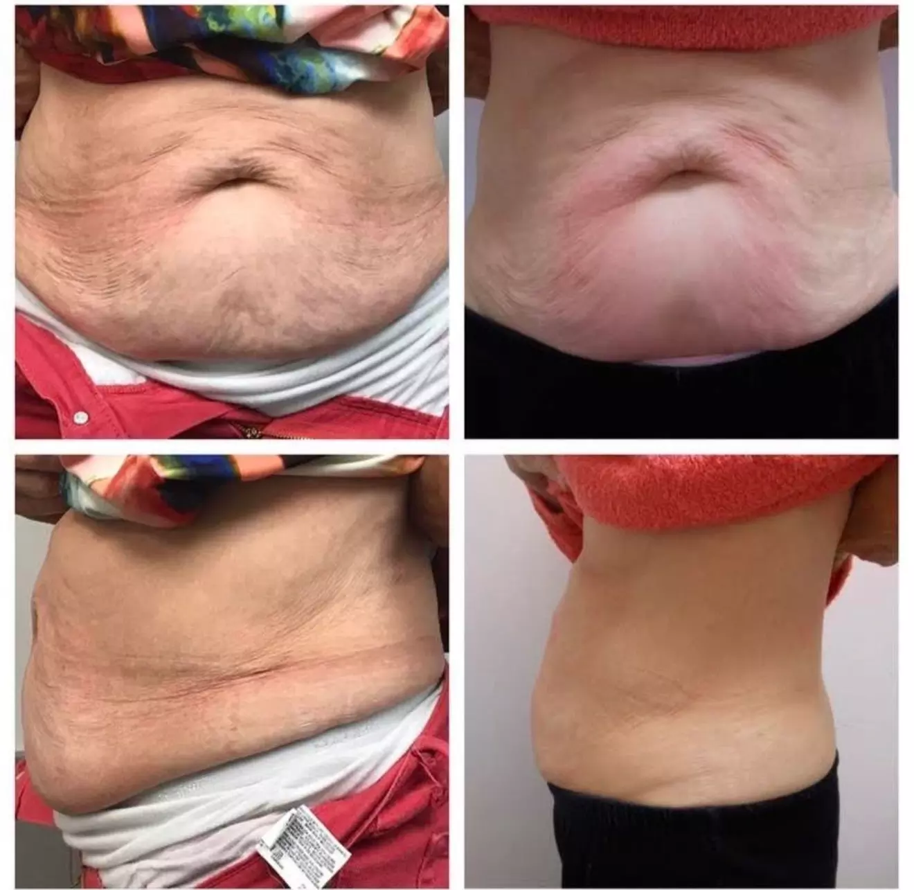 Non-Surgical Solution: Fix Stubborn Fat with Lipo Sculpt Lite