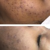 Image 5: Refresh Your Skin w/ 1 or 3 Teen Acne Laser Skin Resurfacing Sessions 