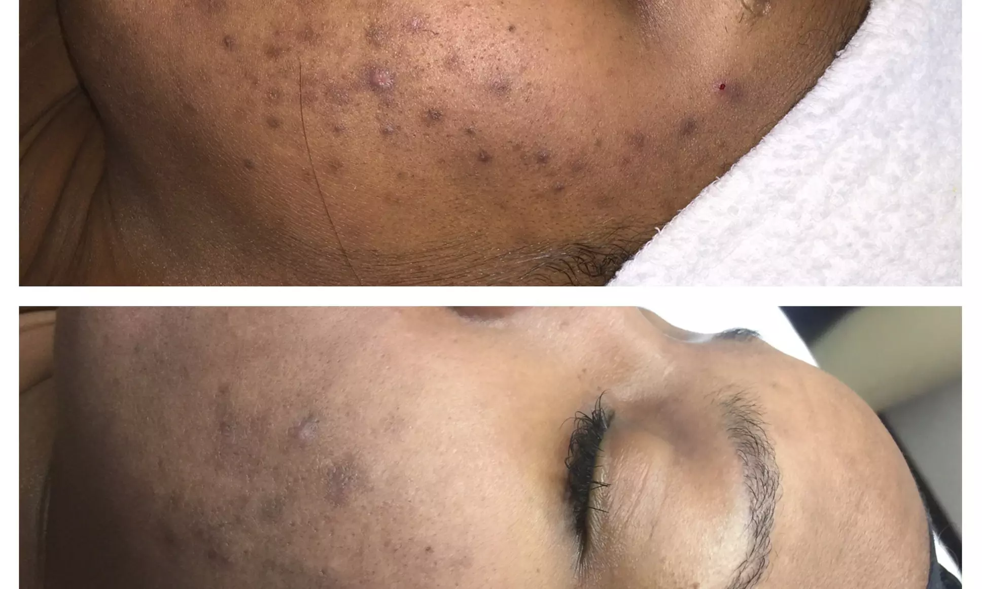 Refresh Your Skin w/ 1 or 3 Teen Acne Laser Skin Resurfacing Sessions