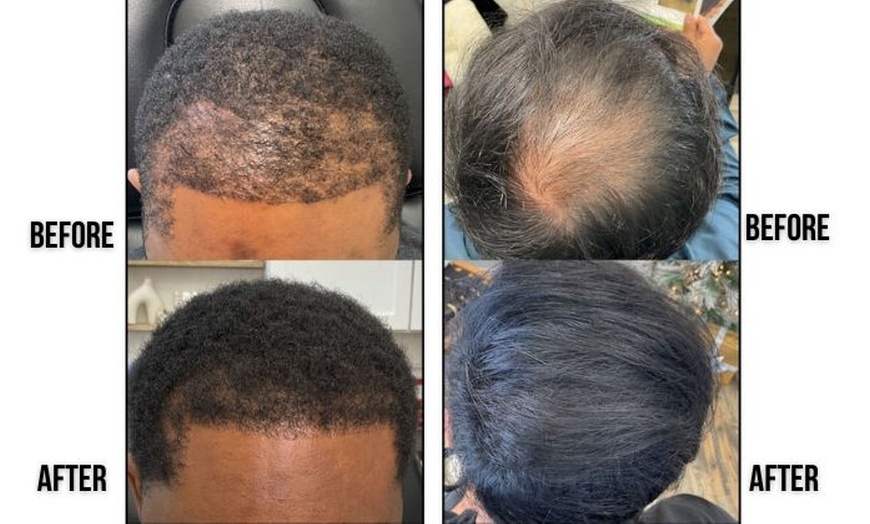 Image 2: Up to 67% Off on Hair Restoration - Non-Surgical at Nude Aesthetics