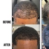 Image 2: Up to 67% Off on Hair Restoration - Non-Surgical at Nude Aesthetics