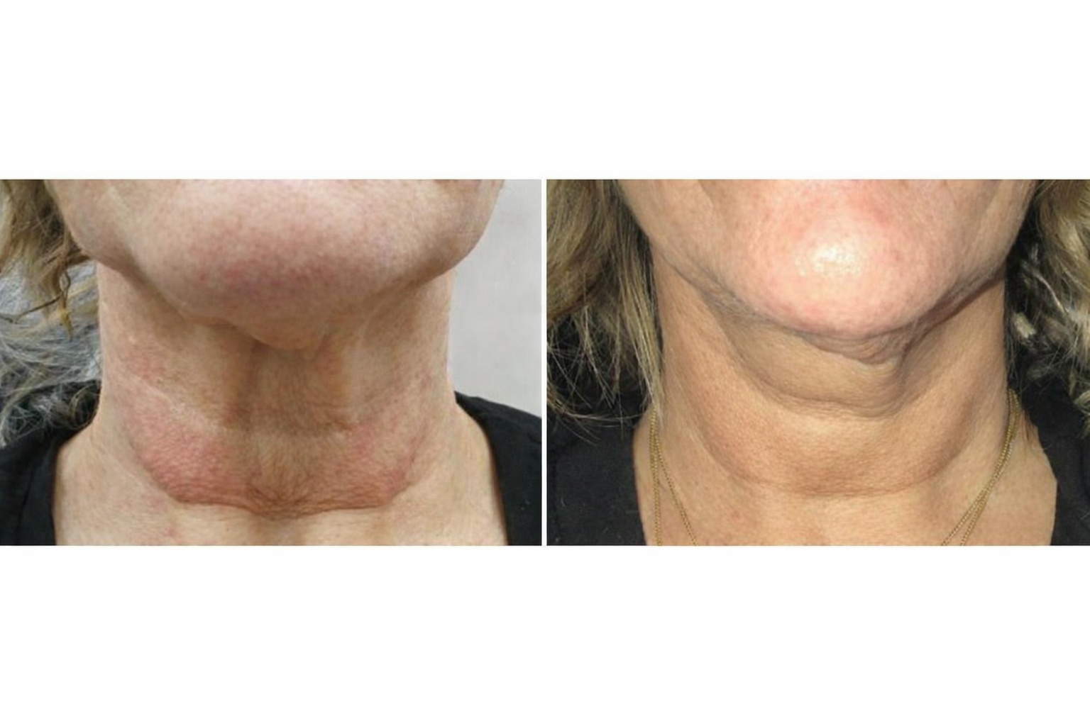Full Face, Neck and Décolletage New Technology HIFU Treatment